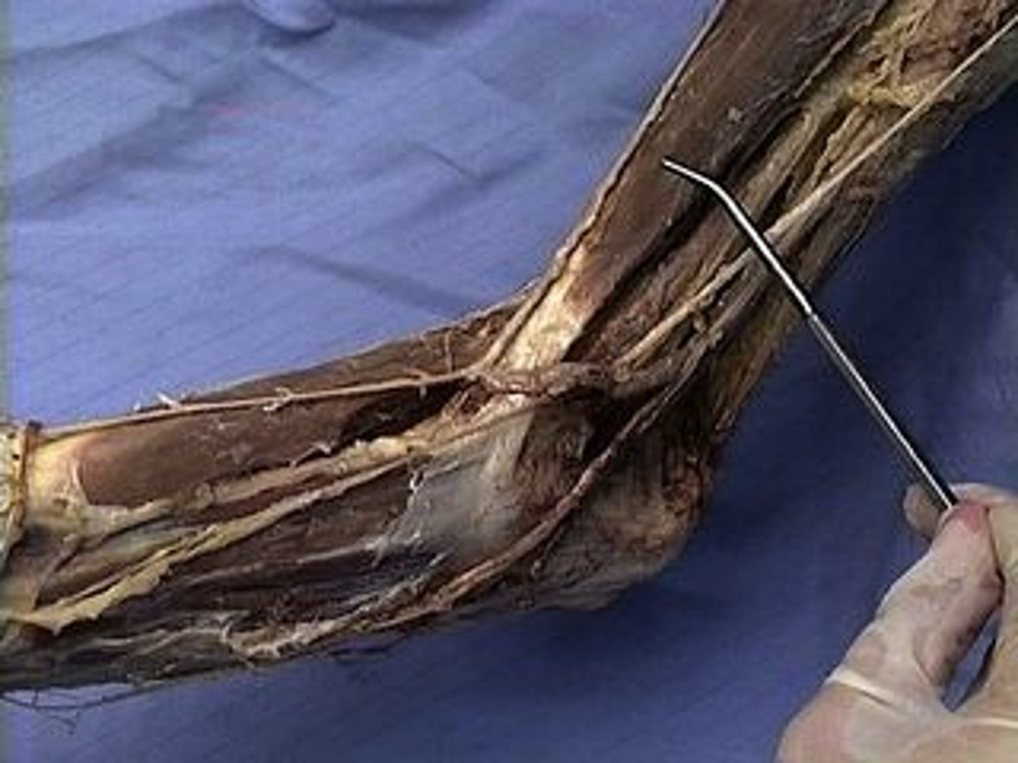 <p>Anterior aspect of upper arm (flexes the elbow)</p>
