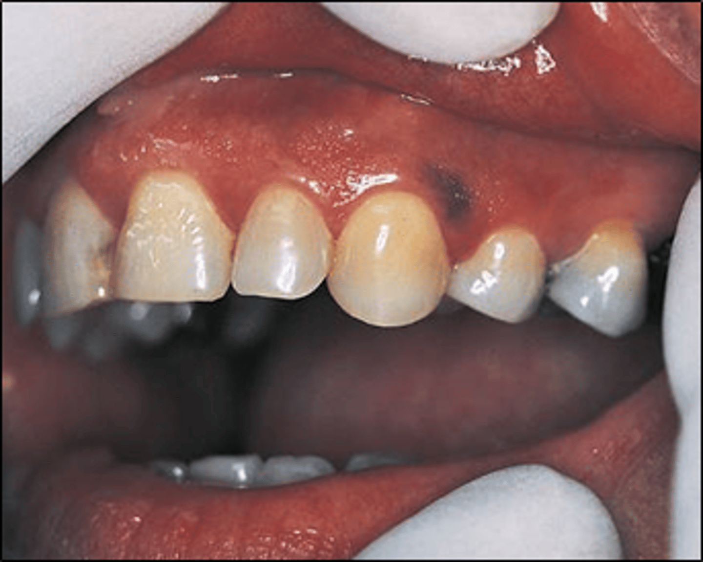 <p>flat, well-defined brown macule</p><p>• common locations: buccal mucosa, gingiva, lips</p>