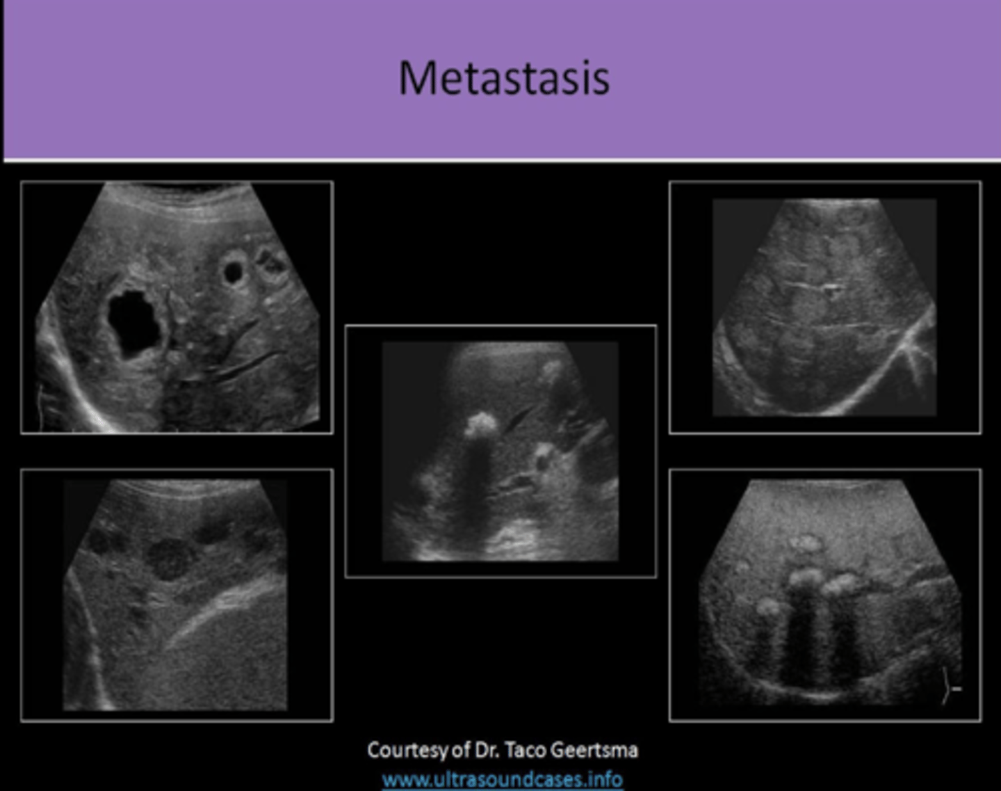 <p>1. MULTIPLE masses<br>2. VARY IN SIZE<br>3. NECROSIS AT CENTER OF LESION as the blood supply is outgrown<br>4. if halo sign is identified around a liver mass, it should create strong suspicion of malignancy<br>5. HYPERECHOIC lesions usually related to GI TRACT PRIMARY OR HCC<br>6. HYPERECHOIC lesions WITH HYPERVASCULARITY usually related to RENAL CELL CARCINOMA<br>7. HYPOECHOIC lesions usually related to LYMPHOMA, LUNG, OR BREAST PRIMARY<br>8. CYSTIC lesions associated with SARCOMA<br>9. BULL'S EYE appearance UNCOMMON AND NONSPECIFIC, but usually related to LUNG OR COLON PRIMARY<br>10. CALCIFIED lesions usually related to MUCINOUS ADENOCARCINOMA OF THE COLON<br>11. INFILTRATED PATTERN related to BREAST, LUNG, AND MELANOMA PRIMARIES<br>12. ABDOMEN should be evaluated for LYMPHADENOPATHY</p>