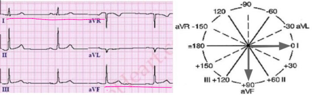 <p><strong>Normal QRS Axis</strong></p><p>-The QRS complex is _______ in Lead I and _______ in aVWF</p>