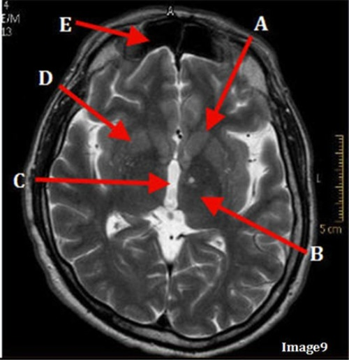 <p>Letter A in Image 9 is pointing to:</p><p>A. Third ventricle</p><p>B. Thalamus</p><p>C. Lentiform nucleus</p><p>D. Caudate nucleus</p>