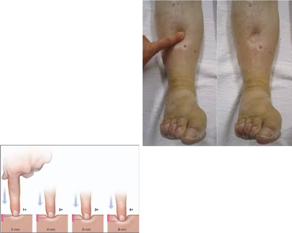 <p>Pitting Edema</p>