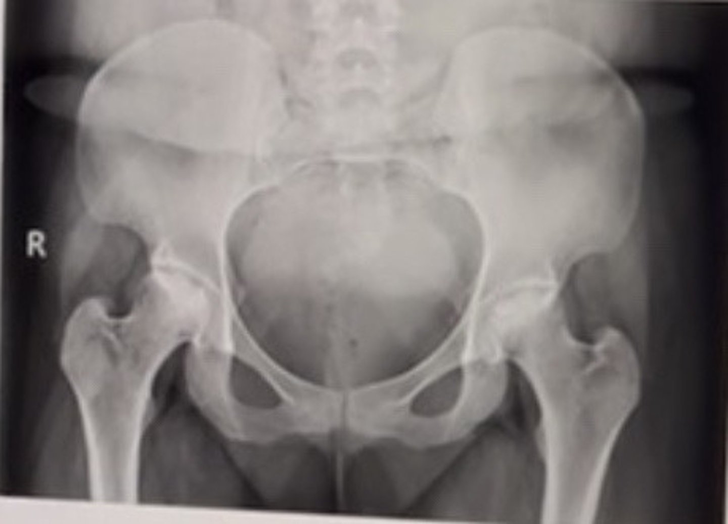 <p>54 year old male with chronic bilateral hip pain. History reveals the patient suffers from alcoholism.</p><p>The most common cause for the above diagnosis is:</p><p>Vitamin D deficiency</p><p>Staphylococcus aureus</p><p>Paramyxovirus</p><p>Corticosteroid use</p>