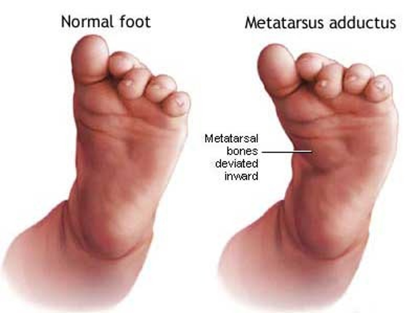 <p>mildest, front part foot turned inward</p>