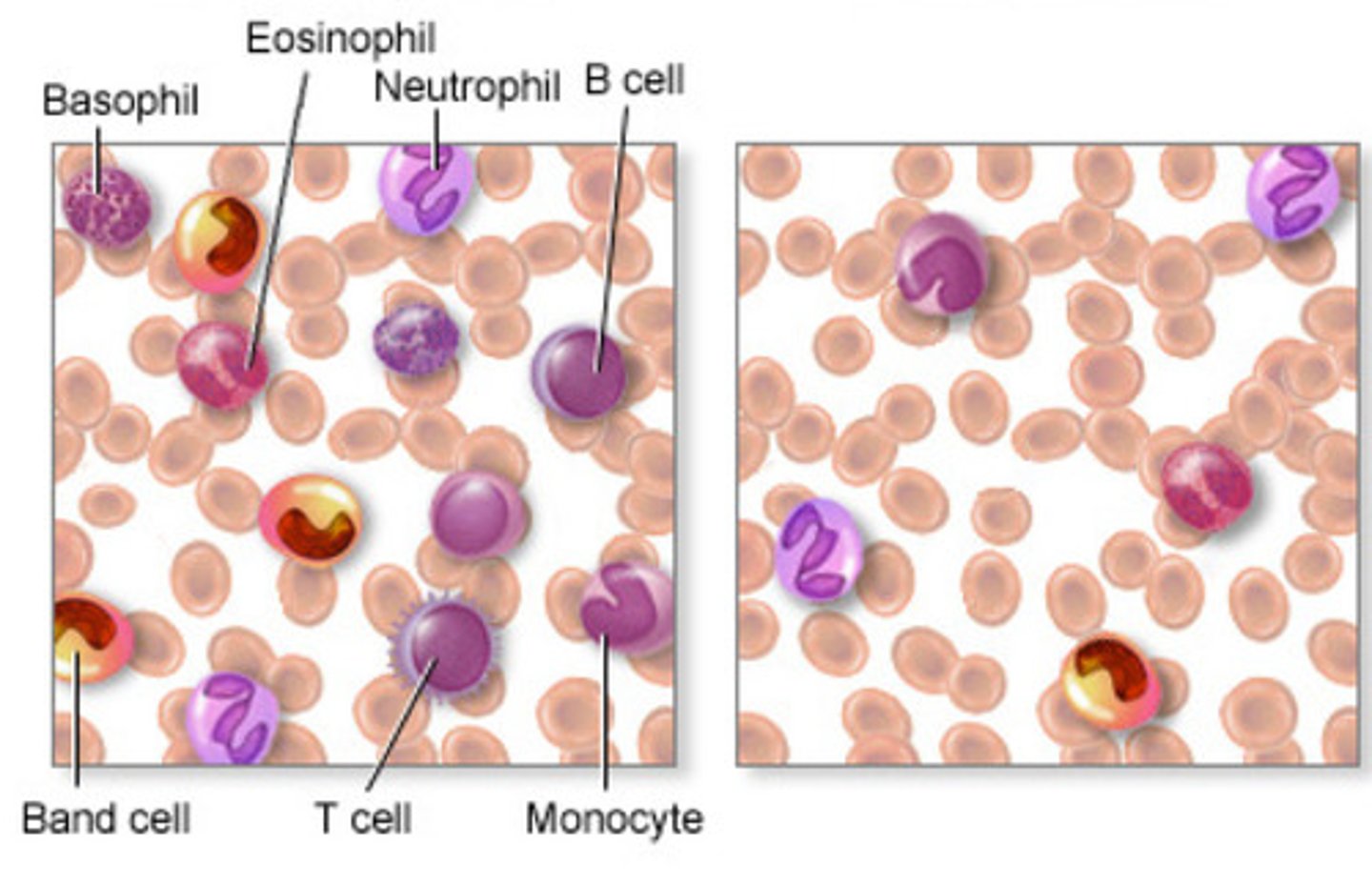 <p>- reduction in the # of leukocytes below 5000mL</p><p>- in contrast to leukocytosis, leukopenia is NEVER BENEFICIAL</p><p>- these are immunosuppressed individuals &amp; infection of any type can be exceptionally dangerous</p><p>- importance of good hand washing &amp; hygiene practices when working w. this population</p>