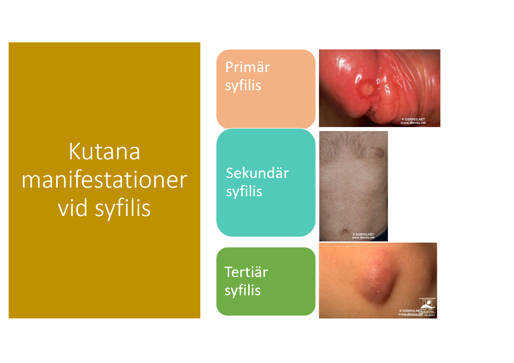 <p>T. pallidum (syfilisbakterien). </p><p>De beter sig på samma sätt, de har olika stadier från infektionstillfället. </p><ul><li><p>Primär syfilis: dagar till veckor, får ett sår.</p></li><li><p>Sekundär syfilis: röda prickar över hela kroppen</p></li><li><p>Tertiär syfilis: kronisk inflammation, knölar i huden. </p></li></ul><p></p>