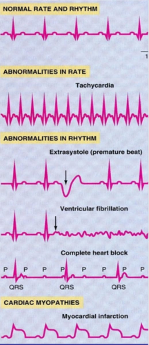 <p>- extrasystole = premature ventricular contraction</p><p>- ventricular fibrilation = no excitation of ventricle (no QRS complex)</p><p>- complete heart block = seperatrion bw atria and ventricel signals lead to av node acting as its own pacemakr --> dissociation bw P wave and QRS</p>