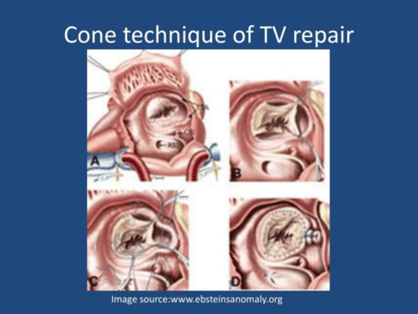 <p>Operative steps for Ebstein’s anomaly repair. </p><p>A:Opened right atrium showing displacement of the tricuspid valve. </p><p>B, Detached part of the anterior and posterior leaflet forming a single piece. </p><p>C, Clockwise rotation of the posterior leaflet edge to be sutured to the anterior leaflet septal edge and plication of the true tricuspid annulus. </p><p>D, Complete valve attachment to the true tricuspid annulus and valved closure of the atrial septal defect.</p><p>May not be tolerated by a very sick baby in which a Starnes procedure may be better alternative for palliation. </p>