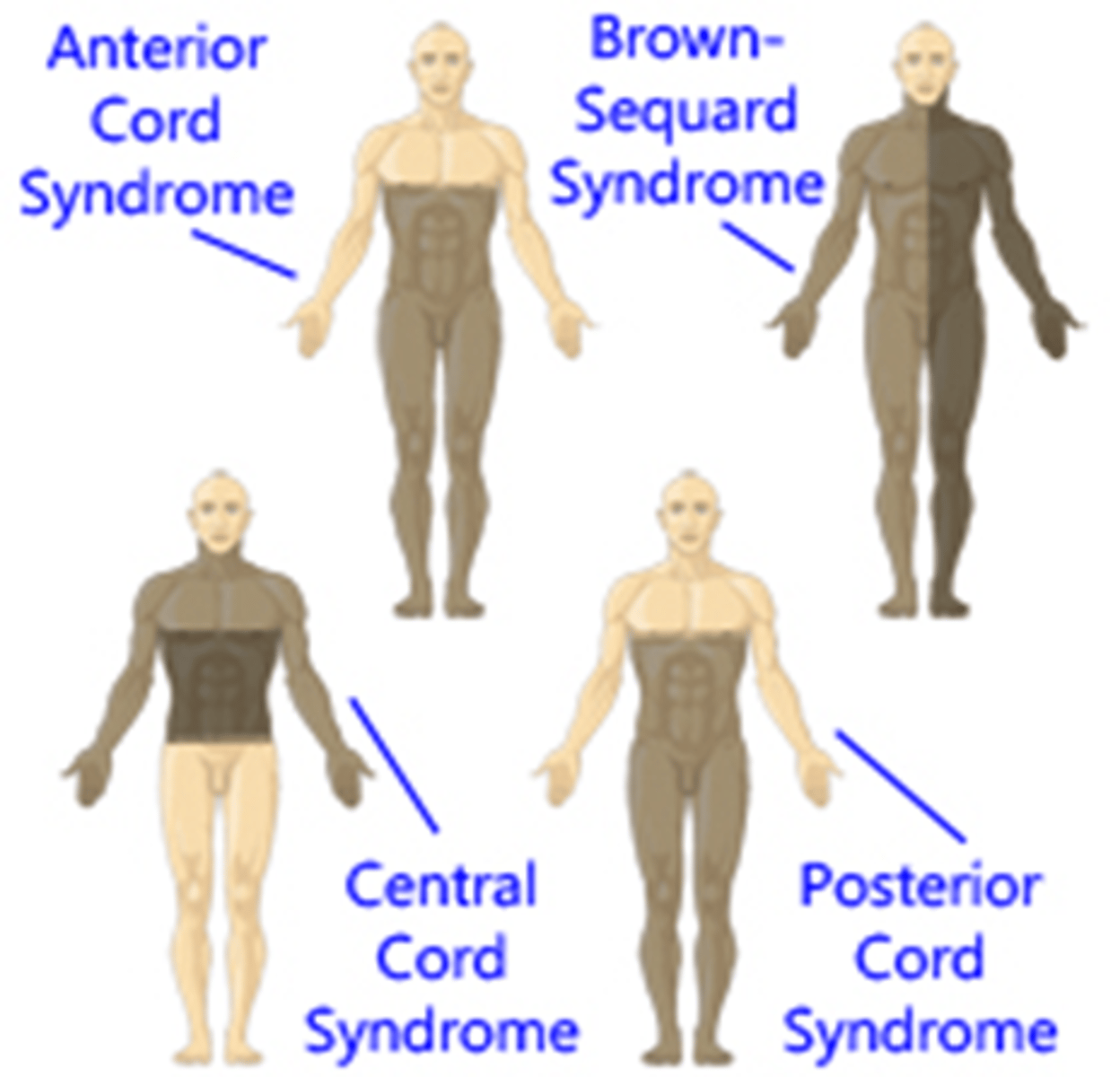<p>o Commonly seen in cervical region</p><p>o Common in older adults</p><p>o Leads to motor weakness and sensory loss w/ dysesthesia pain in UEs</p>