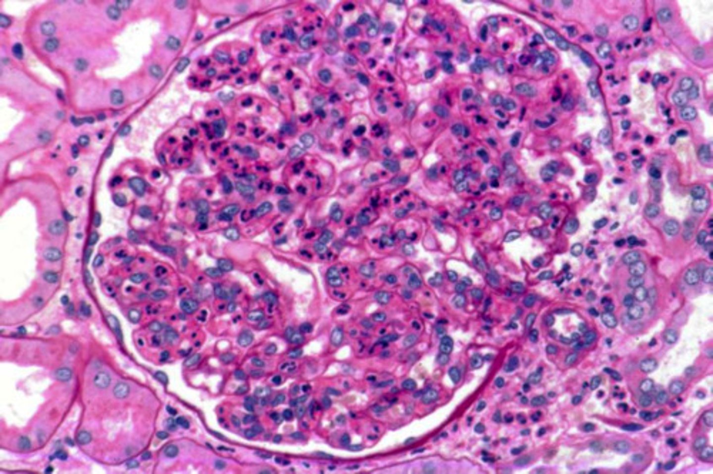<p>inflammation of the glomeruli of the kidney</p>