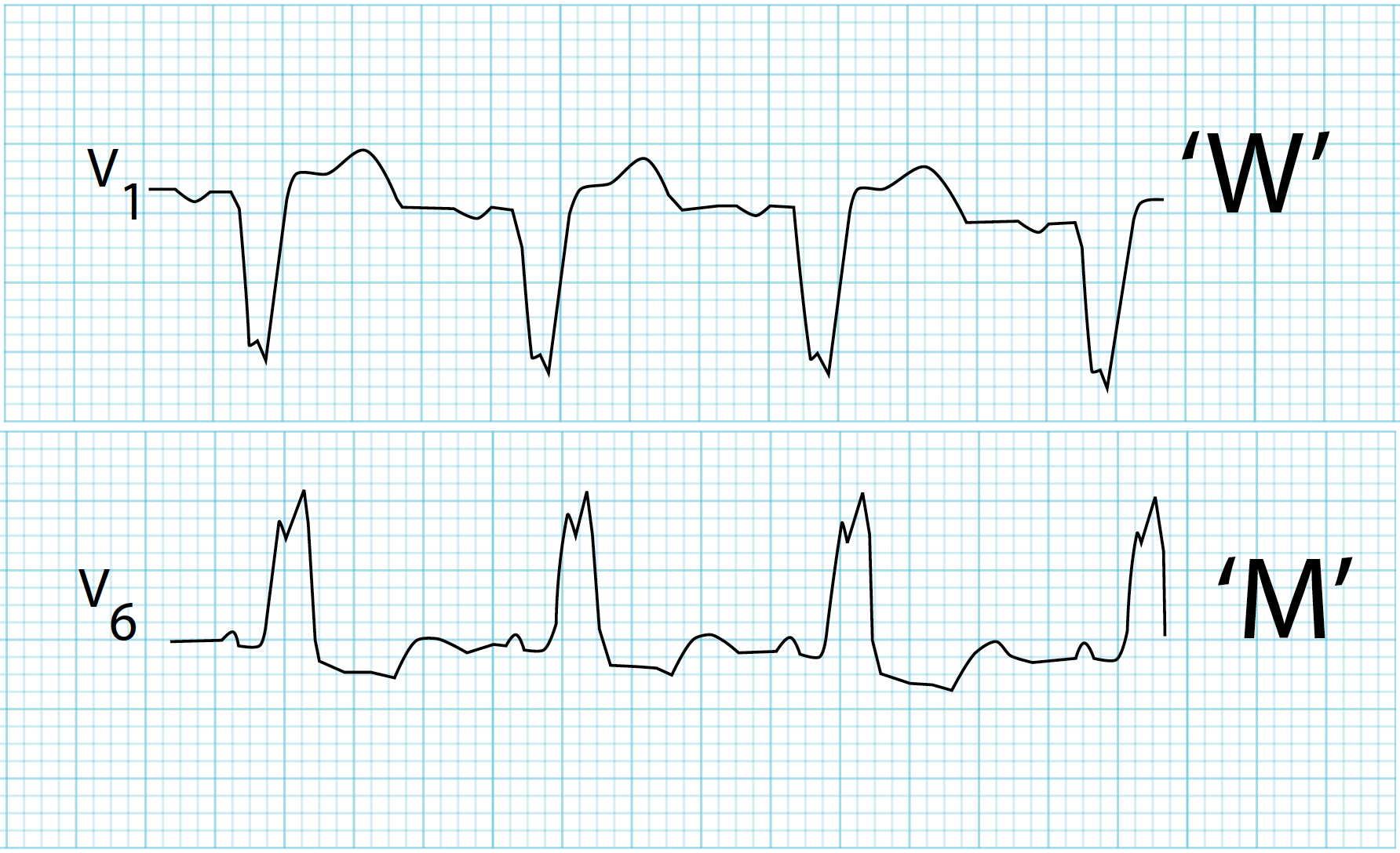 <p>QRS complex starts like a W and moves towards being more like an M.</p>