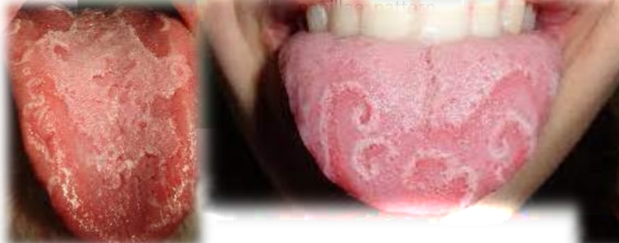 <p><strong><u>Erythema migrans (benign migratory glossitis) “Geographic tongue”</u></strong></p><p class="has-focus">More common in children</p><p class="has-focus"></p><p class="has-focus is-empty"><strong>Treatment </strong> - none required. Topical steroids in symptomatic cases Avoid hot or spicy foods.</p><p class="has-focus is-empty"></p><p class="has-focus is-empty"><em>DD - Median rhomboid glossitis, Contact allergy, Erythematous candidiasis, Transient lingual papillitis, Lichen planus</em></p>