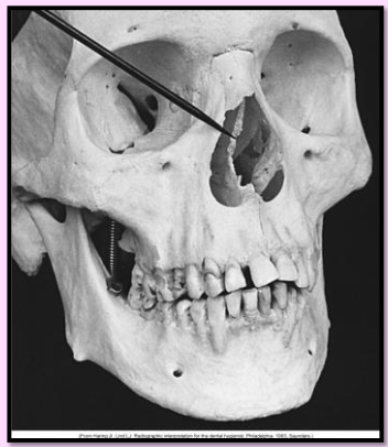 <p>Nasal cavity</p><ul><li><p>pear shaped compartment of bone located superior to the maxilla </p><ul><li><p>inferior portion formed by the palatal processes of the maxilla and horizontal portions of the palatine bone. </p></li></ul></li><li><p><u>Radiography: large</u><strong><u> radiolucent</u></strong><u> area above the max incisors </u></p></li></ul><p></p>