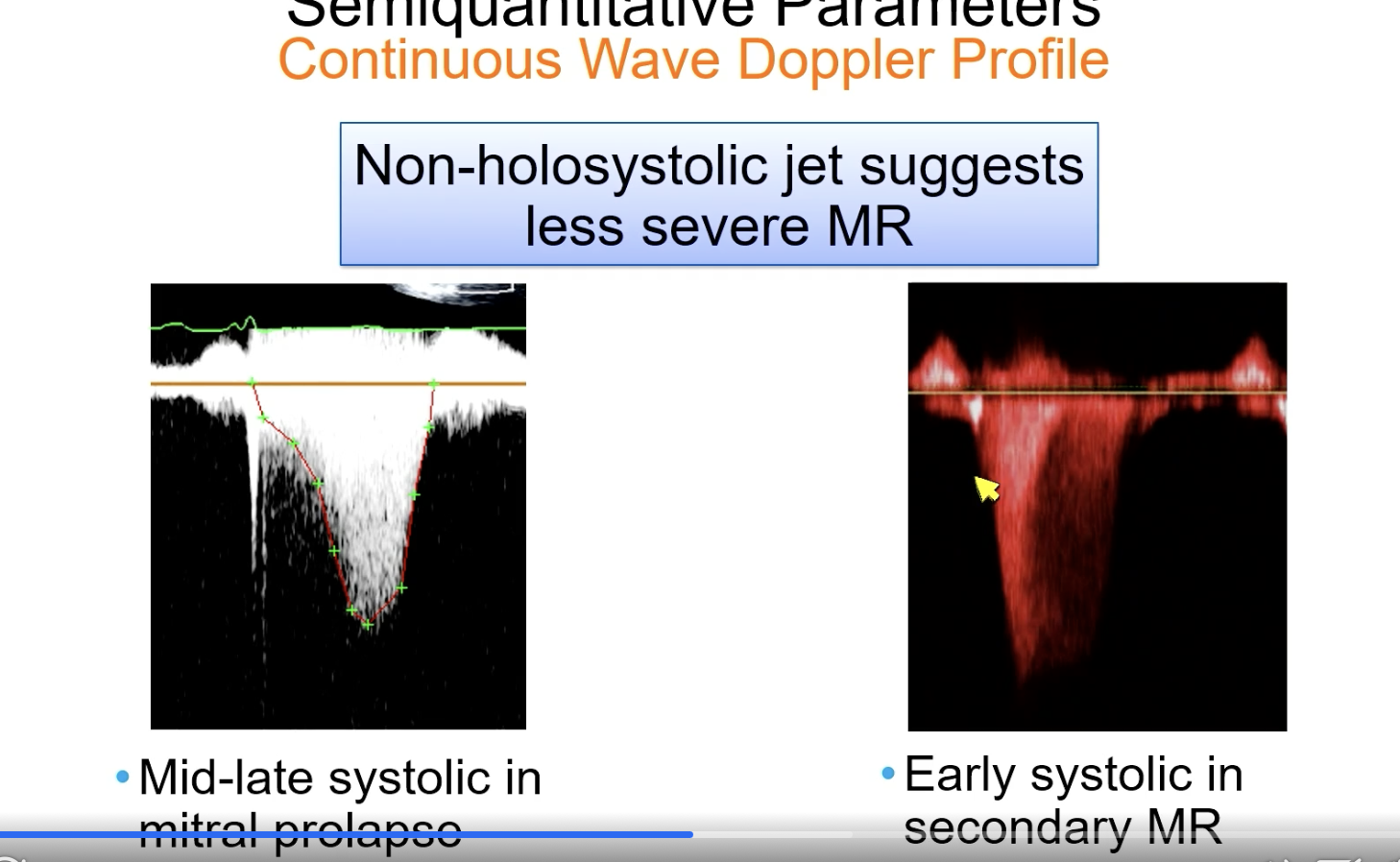 <p>less severe MR</p>