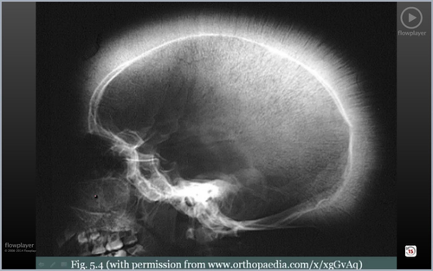 <p>why does skull look like that; Dx; sequelae?</p>
