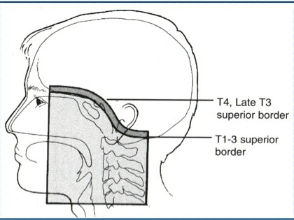 <p>Includes entire sphenoid sinus, cavernous sinus, and base of skull with at least a 0.5 cm margin.</p>