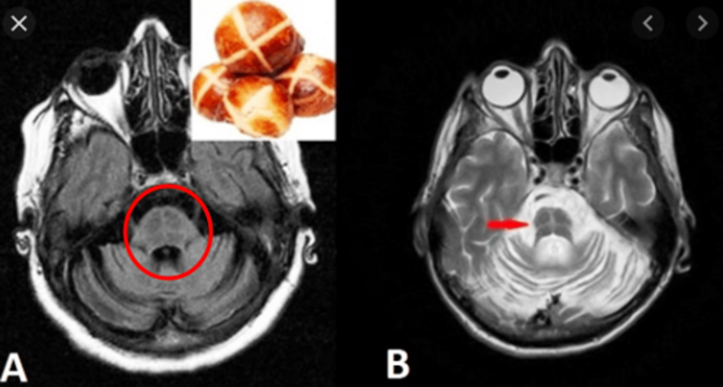 <p>Cross sign on the pons, and cerebellum has atrophy</p>