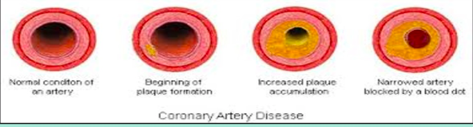 <ul><li><p>Increased plaque accumulation</p></li><li><p>Narrowed artery blocked by a blood clot</p></li></ul><p></p>