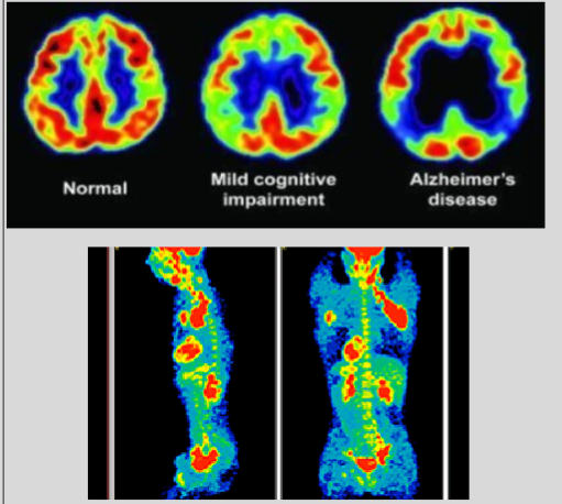 <p>small amounts of radioactive materials called radiotracers collect in areas of higher chemical activity and a special camera + computer evaluates your organ and tissue functions</p>