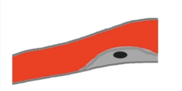 <p>Oval Anechoic area within the plaque.</p>