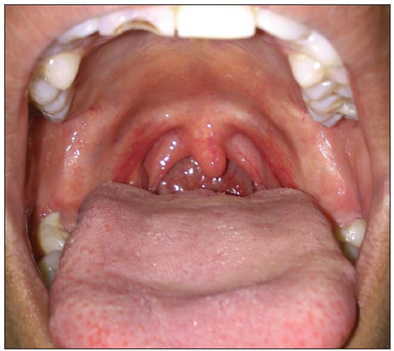<p>B. Right vagus nerve</p>