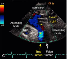 <p>What is seen in this 2D image at the SSN?</p>