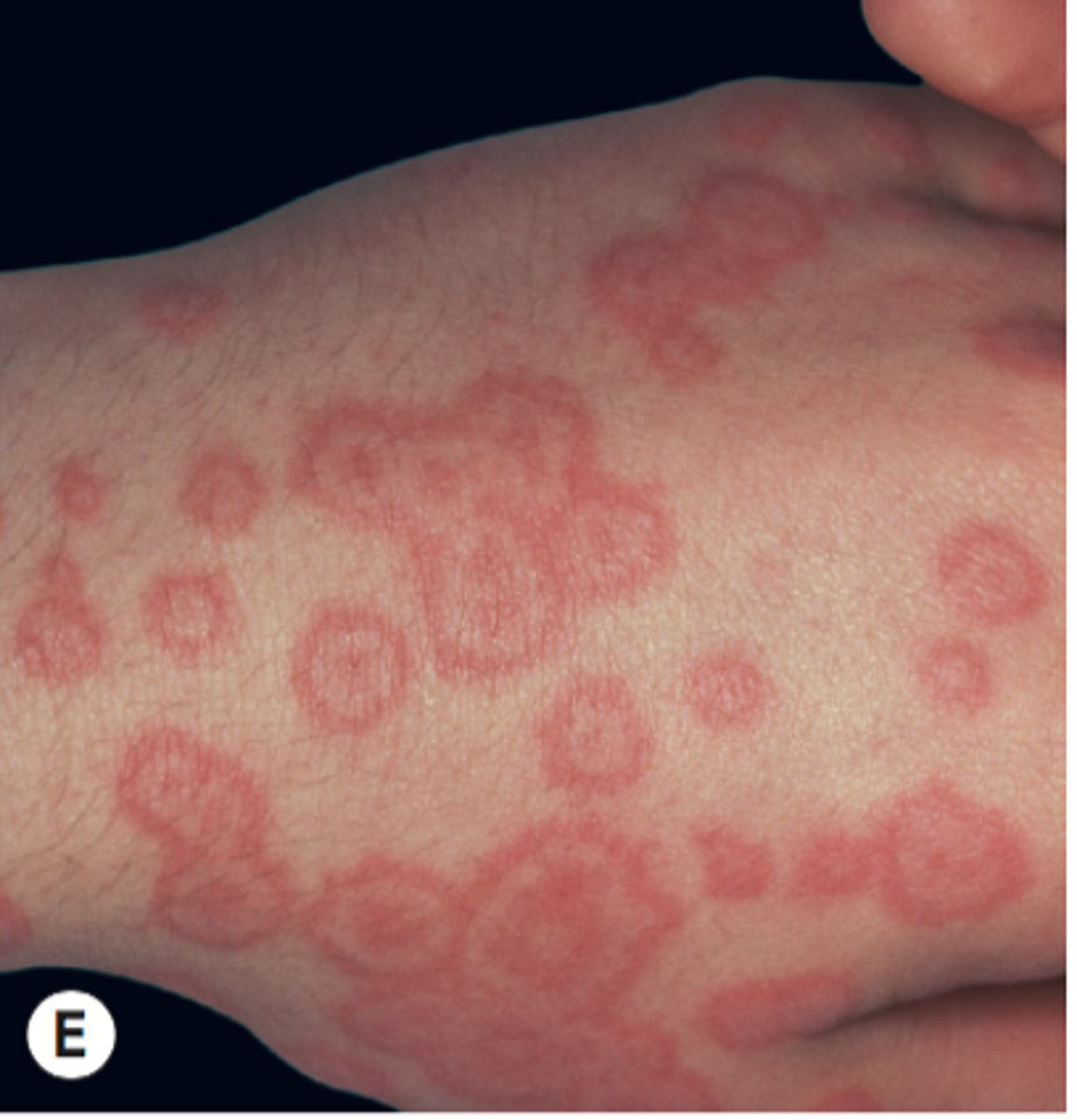 <p>erythema multiforme</p><p>EM minor → mild/no mucosal involvement; no system sxs</p><p>EM major → widespread, severe mucosal involvement + systemic sxs (fever, arthralgia)</p>