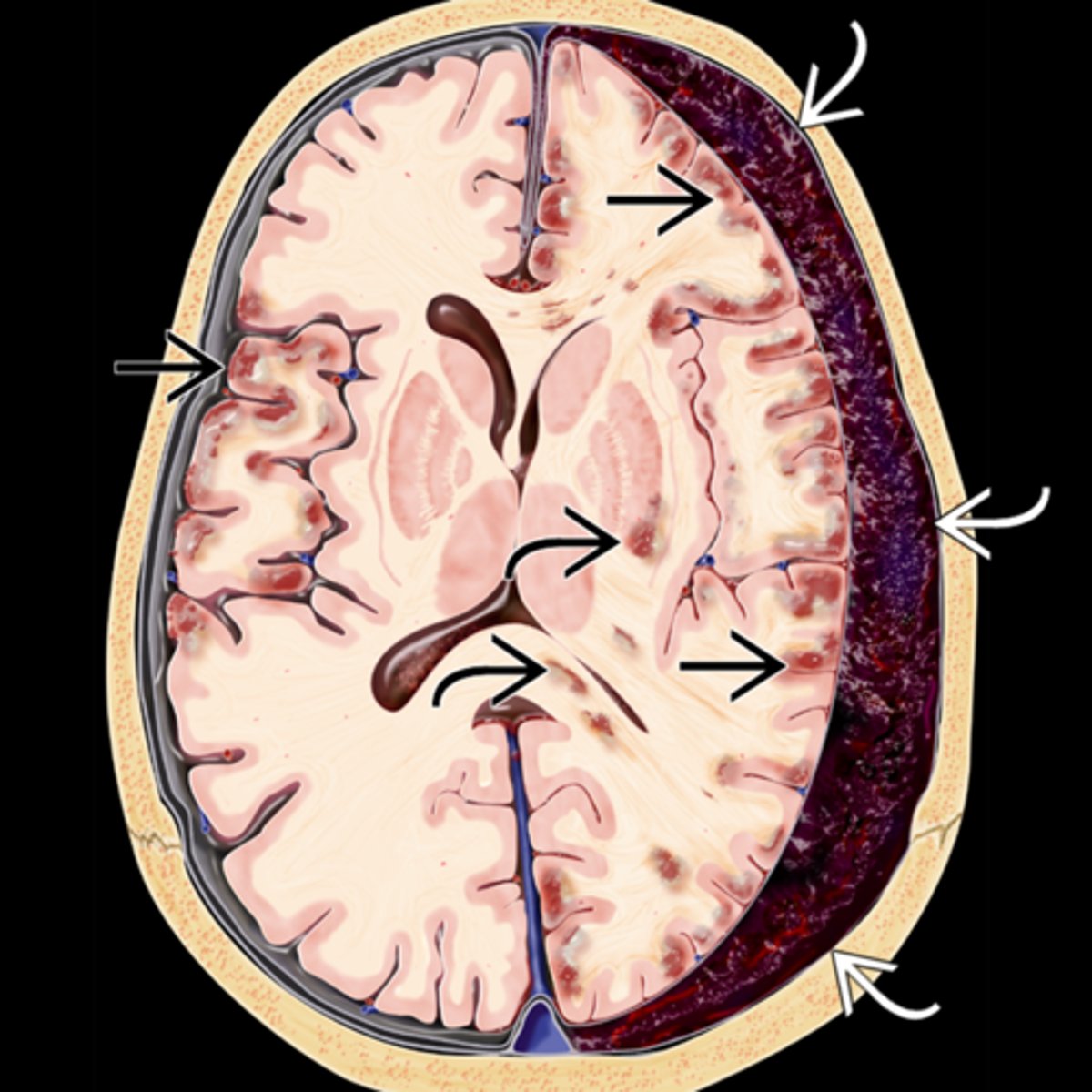 <p>trauma = brain moves ant to post = cerebral veins in subdural space rip = blood fills subdural space = fibrous dura and arachnoid mesothelium beneath create a sac around the cot = sac breaks = blood enters brain = pt is sick and dies</p>