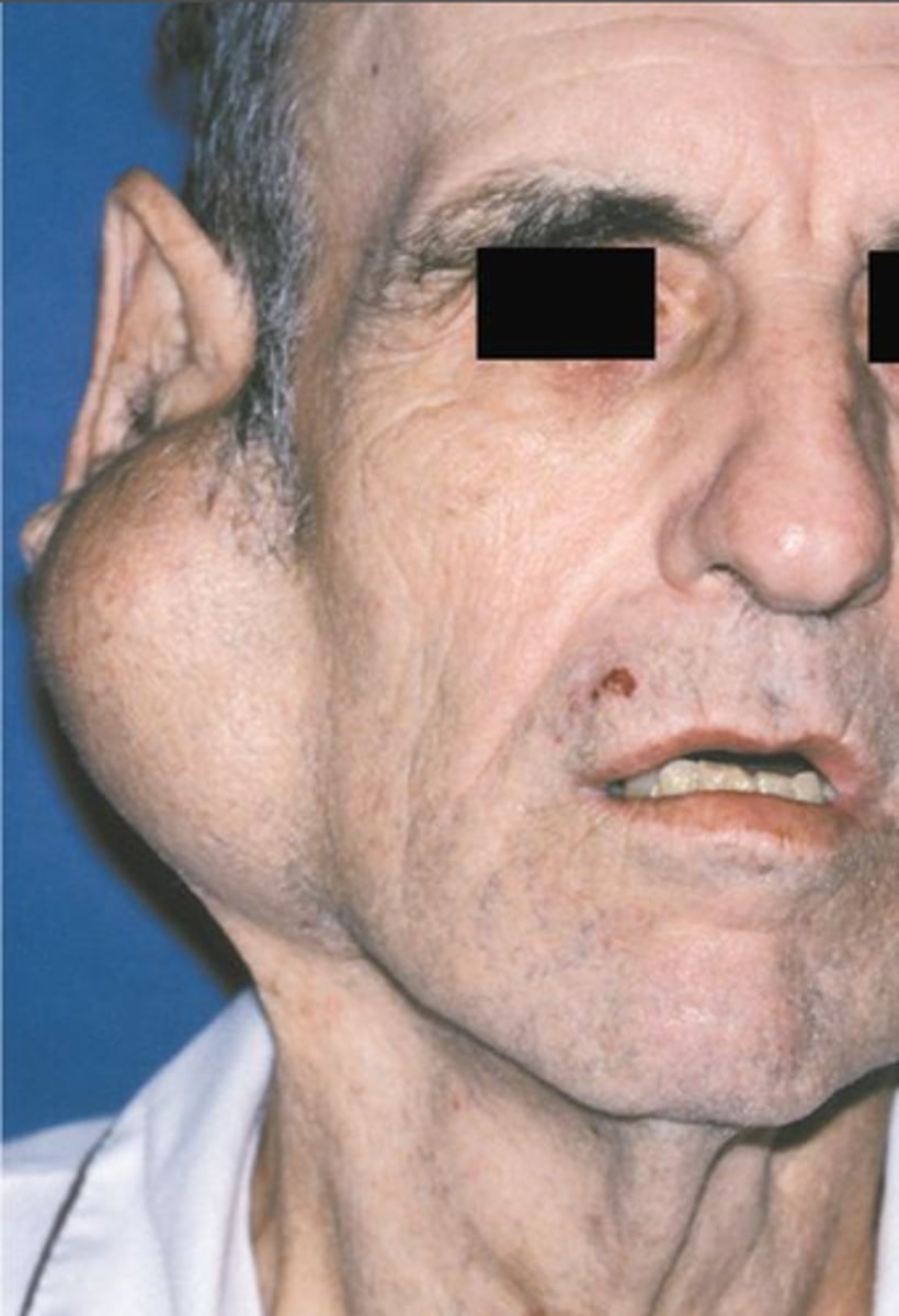 <p>Benign Salivary Gland Tumors:</p><p>Most common salivary gland neoplasm, Mix of epithelial and mesenchymal elements</p>