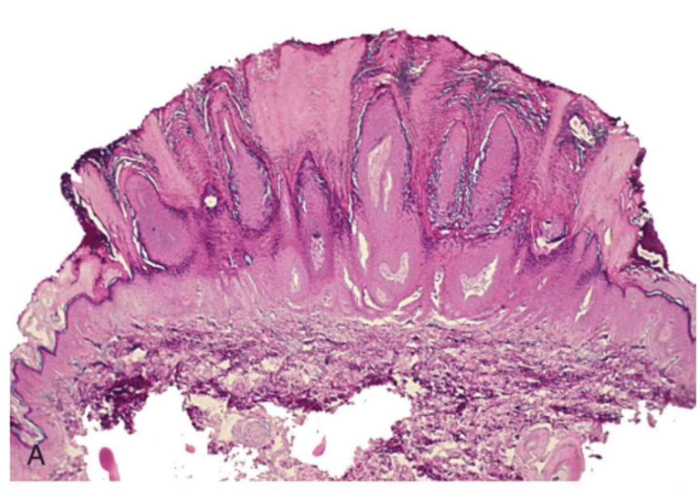 <p>verruca vulgaris histology</p>