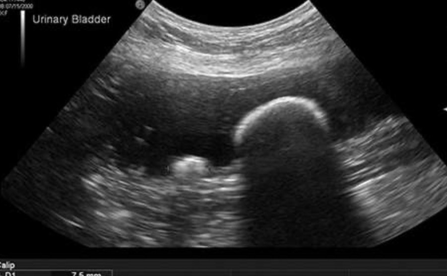 <p>What is the term used to describe the following artefact on this longitudinal scan of the urinary bladder?</p>