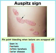 <p>E: most common type of psoriasis</p><p>CM: “silvery” scaling plaques<br>circumscribed<br>erythematous<br>dry</p><p>extensor surfaces:<br>-elbows<br>-knees<br>-scalp<br>-sacrum</p><p><u>auspitz sign:</u><br>pick at silver scales→blood</p><p>TX:<br><u>topical:</u><br><strong>1st line→topical steroids</strong><br>topical calcipotriene<br>anthralin+coal tar<br>narrow band UV x 3x/week</p><p><u>systemic:</u><br>methotrexate<br>acute→cyclosporine+taper off<br>PO acitretin<br>apremilast</p><p><u>Biologics:</u><br><strong>TNF alpha inhibitors:</strong><br>-entanercept<br>-adalimumab</p><p><strong>interleukin 12+23 inhibitor:</strong><br>-ustekinumab</p><p><strong>interleukin 17 inhibitors:</strong><br>-ixekizumab<br>-secukinumab</p><p><strong>interleukin 23 inhibitor:</strong><br>-guselkumab<br>-risankizumab<br>-tildrakizumab</p>