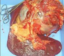 <p>-bleeding tumors</p><p>-mostly due to hemangiosarcoma (but also many other tumor types)</p>