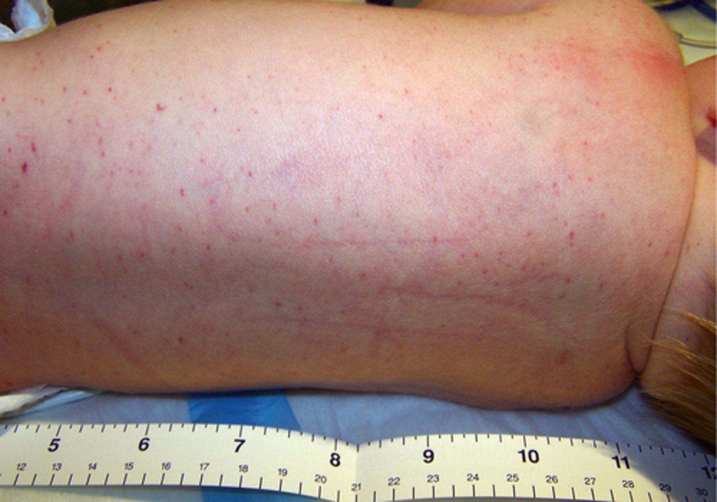 <p>PETECHIAE of the head and face</p>