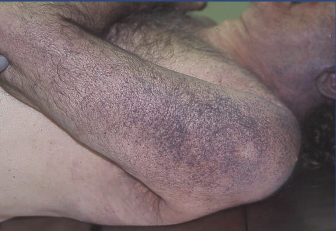 <p>Tardieu spots</p>