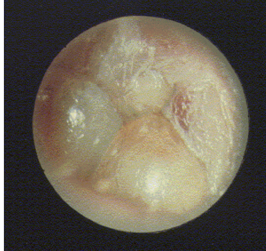 <p><u>disordered otoscopy: eardrum/TM</u></p><p>myringitis</p>