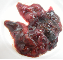 <ul><li><p><span style="background-color: transparent;"><strong><u><span>C. difficile + C. perfringens(safety pins</span></u><span>)</span></strong></span></p><ul><li><p><span style="background-color: transparent;"><strong><span>Dt: </span></strong></span><span style="background-color: transparent; color: green;"><span>PCR + ELISA toxin test </span></span></p><ul><li><p><span style="background-color: transparent; color: green;"><span>culture isolation ≠ disease, find strain + toxin</span></span></p><ul><li><p>Toxin A + B</p></li></ul></li><li><p><span style="background-color: transparent; color: green;"><span>Found in healthy animals(</span></span><span style="background-color: transparent;"><span>C. perfringens): type A causes issues</span></span></p></li></ul></li><li><p><strong>CS</strong>: <span style="color: red;"><strong>Fatal acute hemorrhagic diarrhea</strong></span></p><ul><li><p><span style="color: red;"><strong>Small, large, or diffuse bowel signs</strong></span></p></li></ul></li><li><p>Dx: <strong><u>culture, PCR, ELISA + ELISA toxin test</u></strong></p></li><li><p><span style="background-color: transparent;"><strong><span>Tx: Metro(difficile), </span></strong><span>self limiting, symptomatic </span></span></p><ul><li><p><span style="background-color: transparent; color: green;"><span>Antibiotics only if systemic dz</span></span></p></li></ul></li></ul></li></ul><ul><li><p><span style="background-color: transparent;"><strong><u><span>Acute Hemorrhagic Diarrhea Syndrome (AHDS)</span></u></strong></span></p><ul><li><p><span style="background-color: transparent;"><strong><span>Et: </span></strong></span><span style="background-color: transparent; color: green;"><span>C. perfringens in </span><u><span>young small dog</span></u><span>s</span></span></p></li><li><p><span style="background-color: transparent;"><strong><span>Cs: </span></strong><span> </span></span><span style="background-color: transparent; color: red;"><strong><span>Acute vomiting, </span><u><span>hematemesis progressing to hemorrhagic diarrhea</span></u><span>, Intestinal necrosis </span></strong></span><span style="background-color: transparent; font-size: 1.6rem; color: red;"><strong><span>and inflammation</span></strong></span></p><ul><li><p><span style="background-color: transparent;"><span> “</span></span><span style="background-color: transparent; color: green;"><span>raspberry jam”/bloody</span></span></p></li><li><p><span style="background-color: transparent;"><strong><u><span>**** hemoconcentration → PCV > 60% ****</span></u></strong></span></p></li></ul></li><li><p><strong>Dx</strong>: clinical dx, no test</p></li><li><p><span style="background-color: transparent;"><strong><span>Tx: </span></strong></span><span style="background-color: transparent; color: green;"><span>fluids!*, symptomatic</span></span></p><ul><li><p><span style="background-color: transparent;"><span>No antibiotics unless fever, shock, abnormal WBC</span></span></p><ul><li><p>Ampicillin 1st choice</p></li></ul></li></ul></li><li><p><span style="background-color: transparent;"><strong><span>Px</span></strong><span>: </span></span><span style="background-color: transparent; color: green;"><span>Excellent</span></span></p></li></ul></li></ul><p></p>