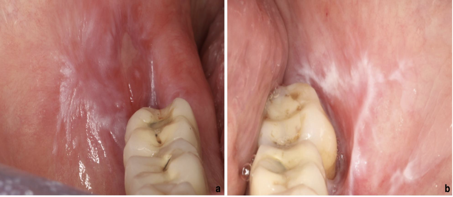 <p>A 45 year old patient presented with bilateral white lace like patches thoroughout buccal mucosa. There is severe burning sensation. What is your diagnosis?</p>