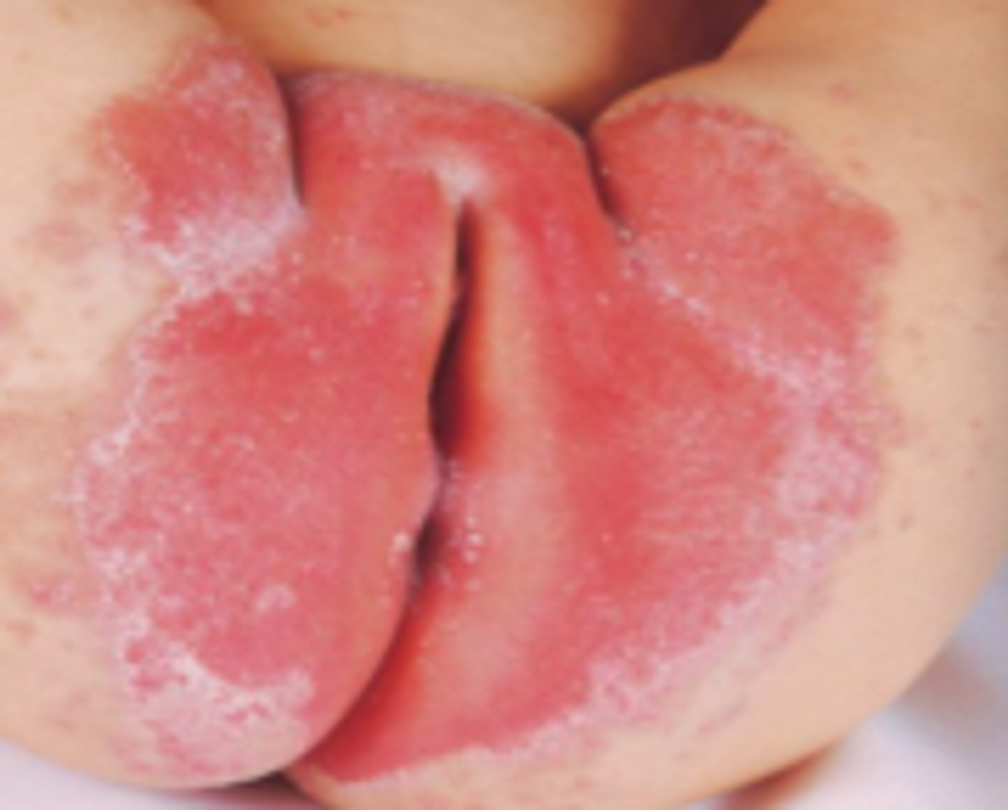 <p>Fungal ID:</p><p>Subjective:</p><p>“Intertrigo”</p><p>- Invades intertriginous areas and areas of occluded skin (moist, occluded sites)</p><p>- Tenderness, extreme itching, and pain</p><p>Primary locations:</p><p>- Axilla, inframammary folds, inguinal folds, other skin folds, diaper location (diaper dermatitis)</p>