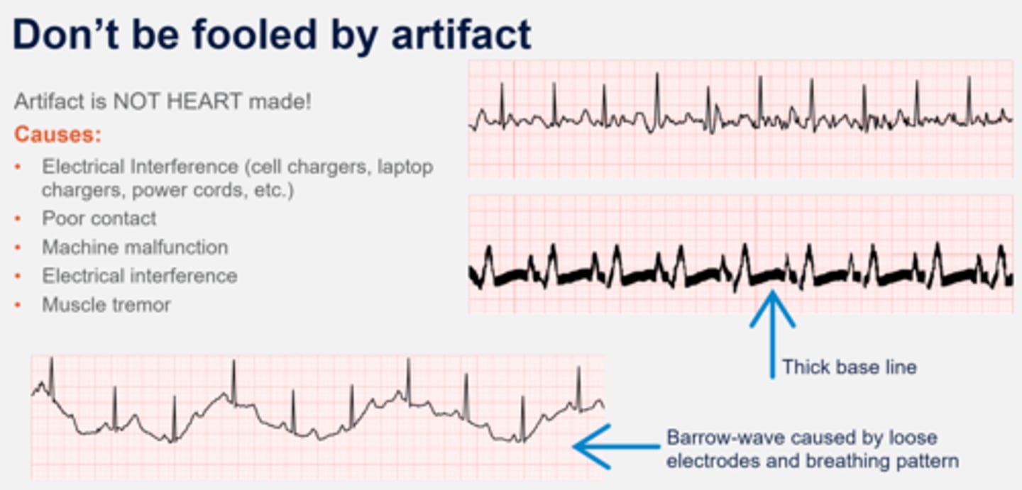 <p>Readings produced by external activity rather than cardiac electrical current</p>