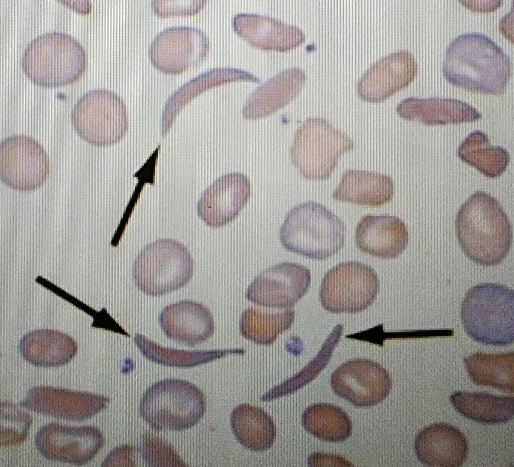 <p>Sickle shaped when blood is exposed to air </p>