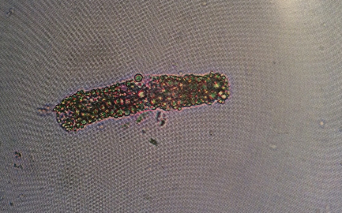 <p>Cast with incorporated fat droplets. If cholesterol is present it makes a Maltese cross under light. </p><p>Seen with diabetes, and nephrotic syndrome. </p>