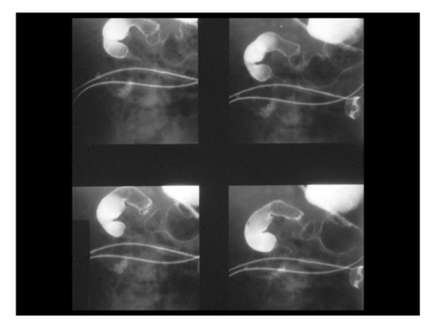 <p>Define Condition:</p><p>When SI wraps around SMA</p><p>-Hx:</p><p>&gt; MALROTATION (30%) --&gt; babies in first months of life</p><p>-Path:</p><p>&gt; SI squeezes SMA --&gt; cuts off blood supply to SI and LI</p><p>&gt; Coiling of SI (d/t poor attachment to posterior abdominal wall) ==&gt; Bowel Obstruction</p><p>-Sx/PE:</p><p>&gt; Sx of Malrotation</p><p>&gt;&gt; Asx</p><p>&gt;&gt; Abdominal Discomfort</p><p>&gt;&gt; Vomiting (Bilious or Nonbilious, depending on obstruction location)</p><p>&gt;&gt; Poor Feeding</p><p>&gt;&gt; Poor Weight Gain</p><p>&gt; Ischemia</p><p>&gt;&gt; Severe &amp; SUDDEN Pain</p><p>&gt;&gt; Bloody Stool</p><p>&gt;&gt; CV Issues (tachycardia, hypotension, sepsis)</p><p>-Dx:</p><p>&gt; Ultrasounds (risk of false negatives)</p><p>&gt; Upper GI Series (more accurate)</p><p>-Tx:</p><p>&gt; Manual Detorsion (Untwist) of SI</p><p>&gt; Cut fibrous connection between posterior abdominal wall and duodenum</p><p>&gt; Reposition intestines to prevent Volvulus</p>