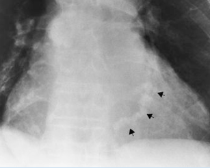<p>this is coronary artery disease, what is the tx</p>