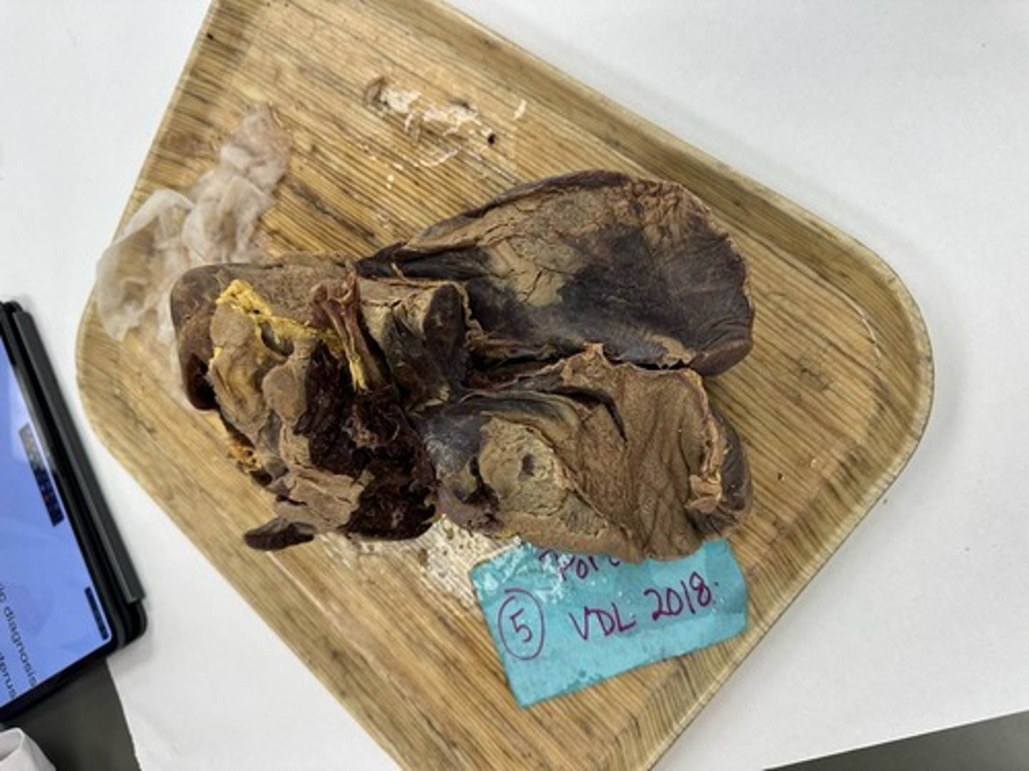 <p>Give morphological diagnosis</p>