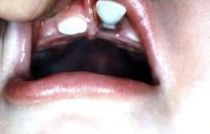 <p>what type of periodontal tissue injury is this </p>