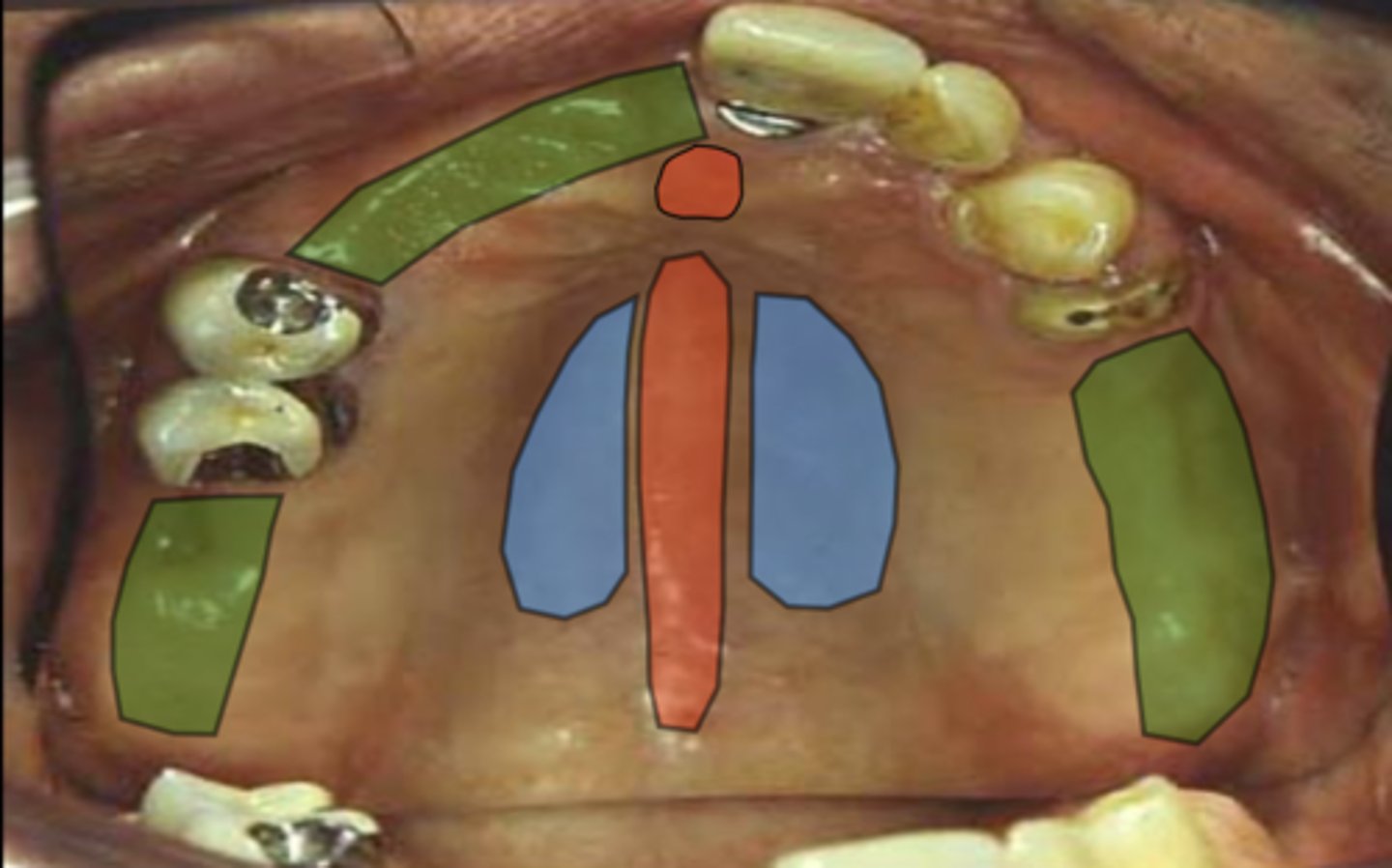 <p>What does the area in blue represent in terms of stress-bearing areas?</p>