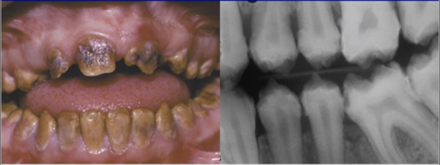 <p>-normal amount of enamel</p><p>-decreased mineralization</p><p>-very soft; rapidly lost</p><p>-radiodensity like dentin</p><p>-yellow-brown/orange color → turns black (decay)</p><p>-normal shape at eruption → wears down quickly </p>