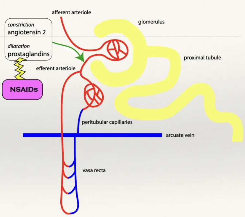 <p>NSAIDs rarely cause AKI in healthy patients with normal BP</p><ol><li><p>Decreased BP detected by JG cells which activates RAAS</p></li><li><p>Angiotensin II released causes generalised vasoconstriction (i.e. efferent arteriole constriction)</p></li><li><p>Efferent arteriole constriction results in increased GFR and stabilisation of pressure</p></li><li><p>PG acts as angiotensin II ANTAGONIST to cause vasodilation and relieve pressure in the efferent arteriole (maintains homeostasis)</p></li></ol><p></p>