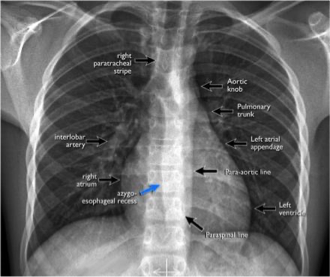 <p>What does this refer to</p><ul><li><p>Contour</p></li><li><p>Heart</p></li><li><p>Effusion</p></li><li><p>Symmetry</p></li><li><p>Trachea</p></li></ul><p></p>